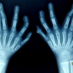 alg_31-fingers_small1 Η επέμβαση διήρκησε έξι ώρες και 30 λεπτά