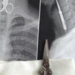 27χρονος κατάπιε ψαλίδι εννέα εκατοστών!