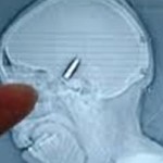 Πολωνός ζούσε με μία σφαίρα στο κεφάλι