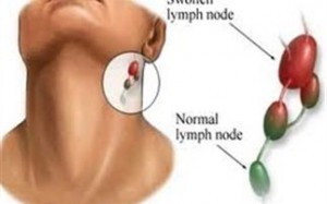 Η ασθένεια του φιλιού