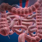 Καρκίνος του παχέος εντέρου