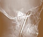 Είχε μαχαίρι μήκους 10 εκατ. καρφωμένο στο κεφάλι του για 4 χρόνια!