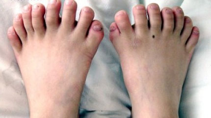 Παιδί με 31 δάκτυλα