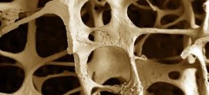 Οστεοπόρωση