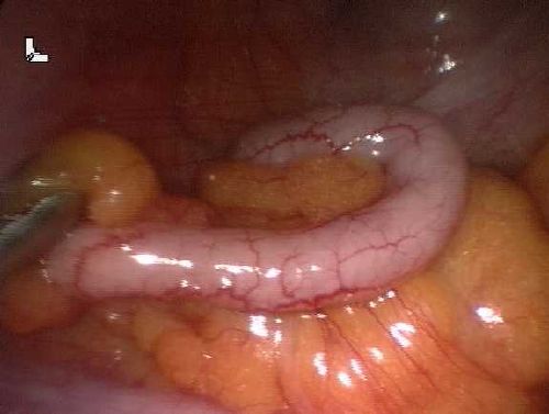 Ποια είναι τα συμπτώματα της σκωληκοειδίτιδας;