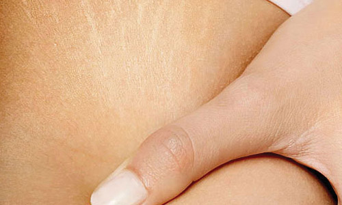 Ραγάδες: Πρόληψη και Θεραπεία.