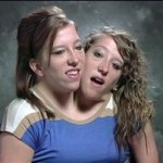 Σιαμαίες δίδυμες ζουν στο ίδιο σώμα