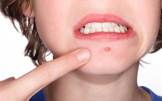 Το καλοκαίρι στην… ακµή του